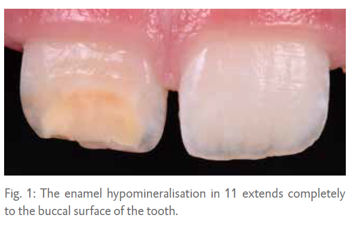 Fig. 1: The enamel hypomineralisation in 11 extends completely to the buccal surface of the tooth.